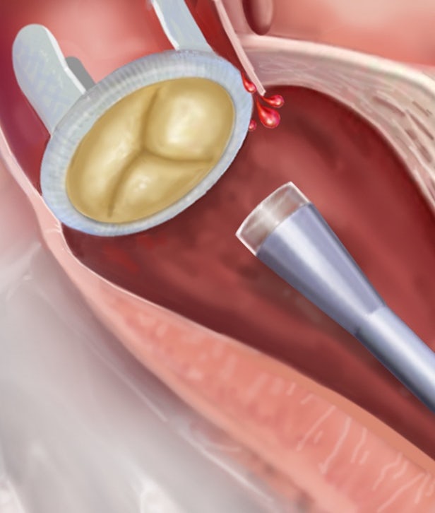 autonomous-catheter-heart-4.jpg