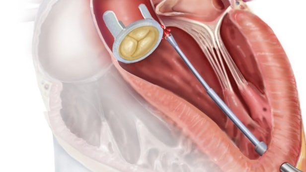 autonomous-catheter-heart-3.jpg