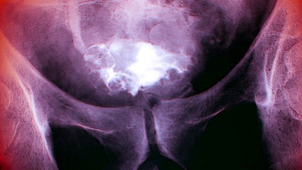 _107743752_m1340841-bladder_cancer_x-ray-spl.jpg