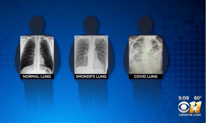 normal-vs-smokers-vs-coronavirus-lungs-x-ray.jpg