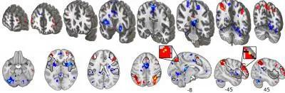 功能核磁共振显示，疼痛过程中，与构建疼痛体验相关的脑区（蓝色）活动减弱，与认知和记忆相关的脑区（红色和黄色）活动加强