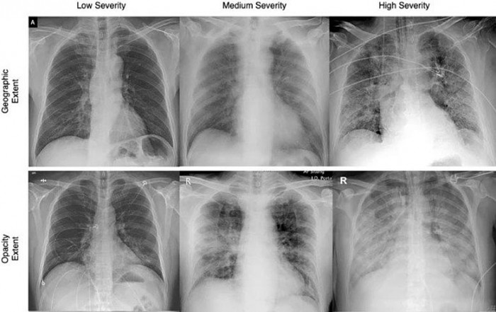 COVID-Chest-X-rays.jpg