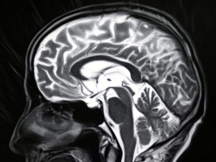 Human-Brain-MRI-Image-777x583.jpg