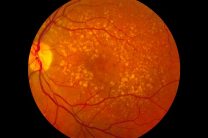 Macular-Degeneration.jpg