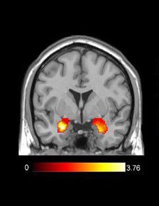 标准fMRI图像。高亮部分显示杏仁核被激活。