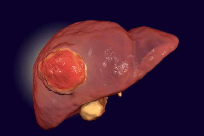 Liver-Cancer-777x518.jpg