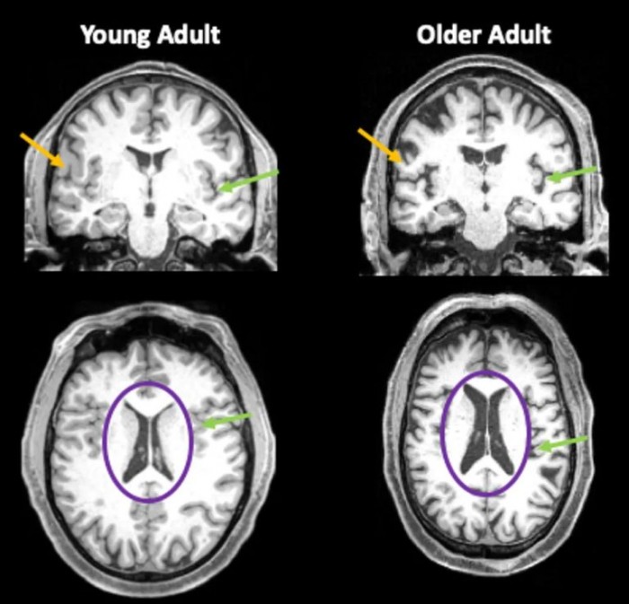 Brain-Images-Young-and-Old-768x738.jpg