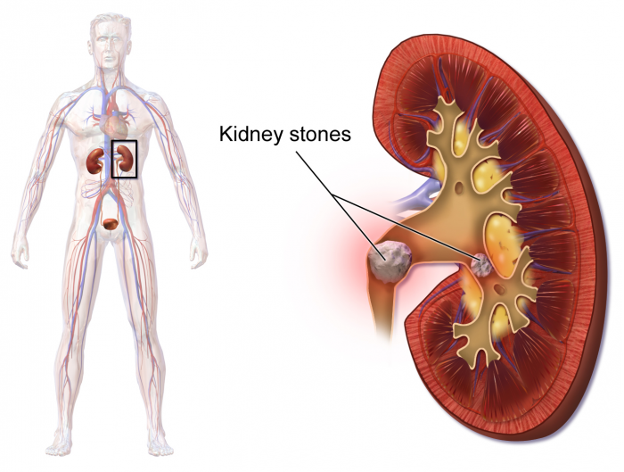 Blausen_0595_KidneyStones.png