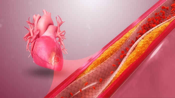 1600px-Coronary_Artery_Disease.jpg