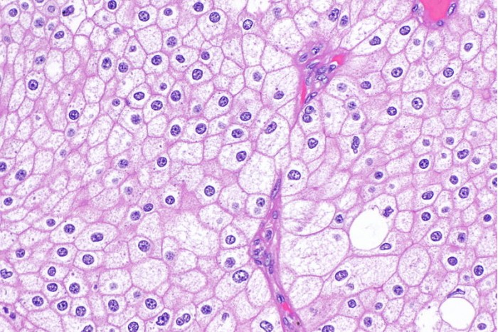 Chromophobe_renal_cell_carcinoma_--_high_mag.jpg