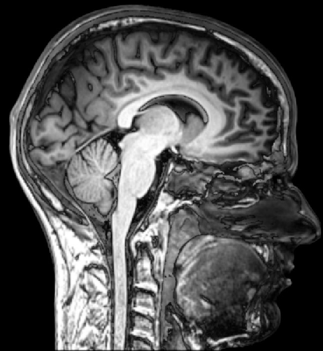 MRI_brain_sagittal_section.jpg