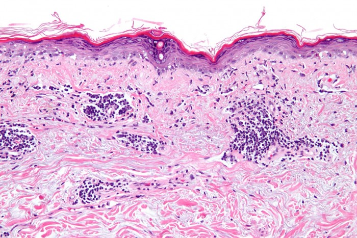 1599px-Vacuolar_interface_dermatitis_-_high_mag.jpg