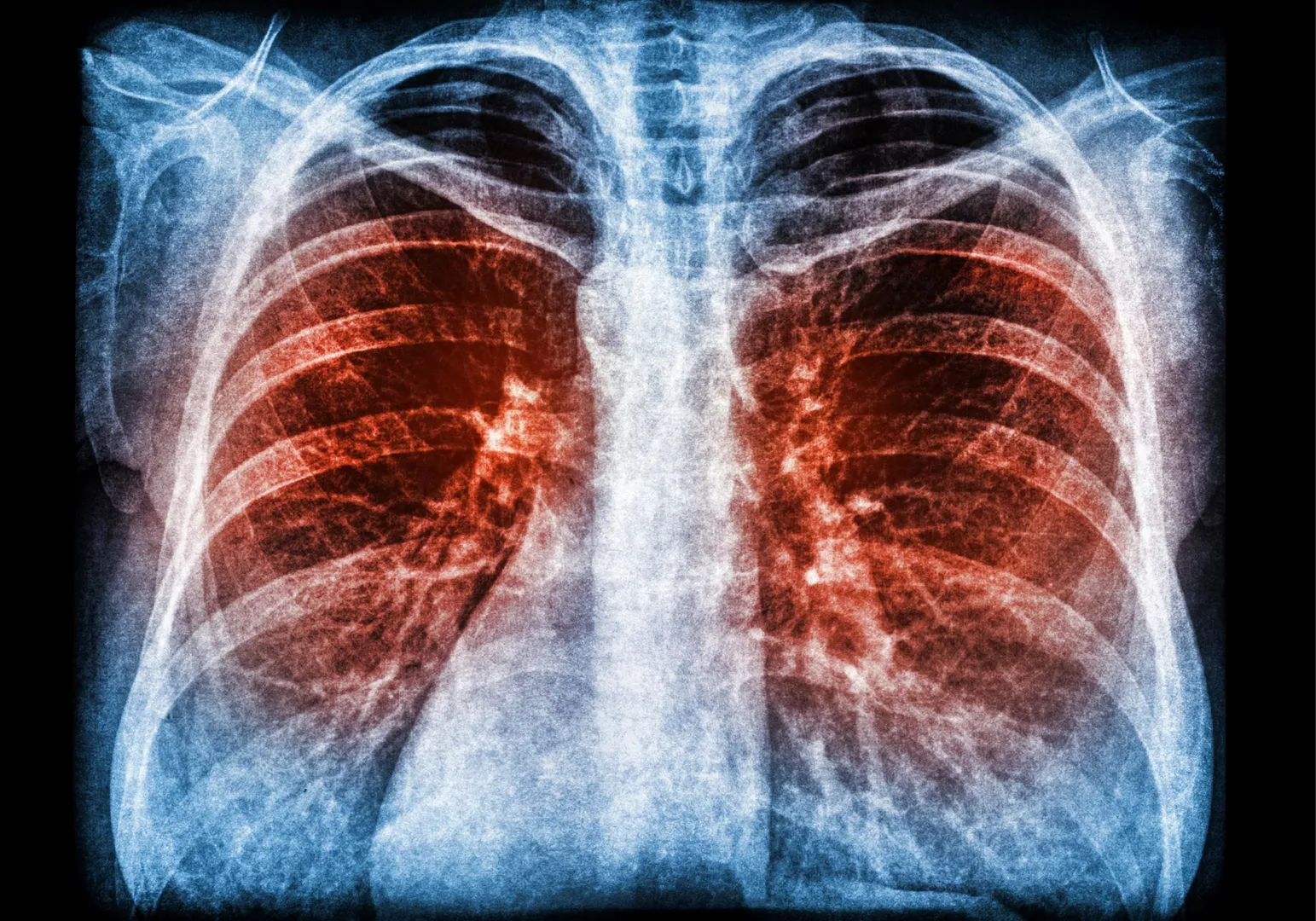 X-Ray-Scan-Pneumonia-Lung-Infection.webp