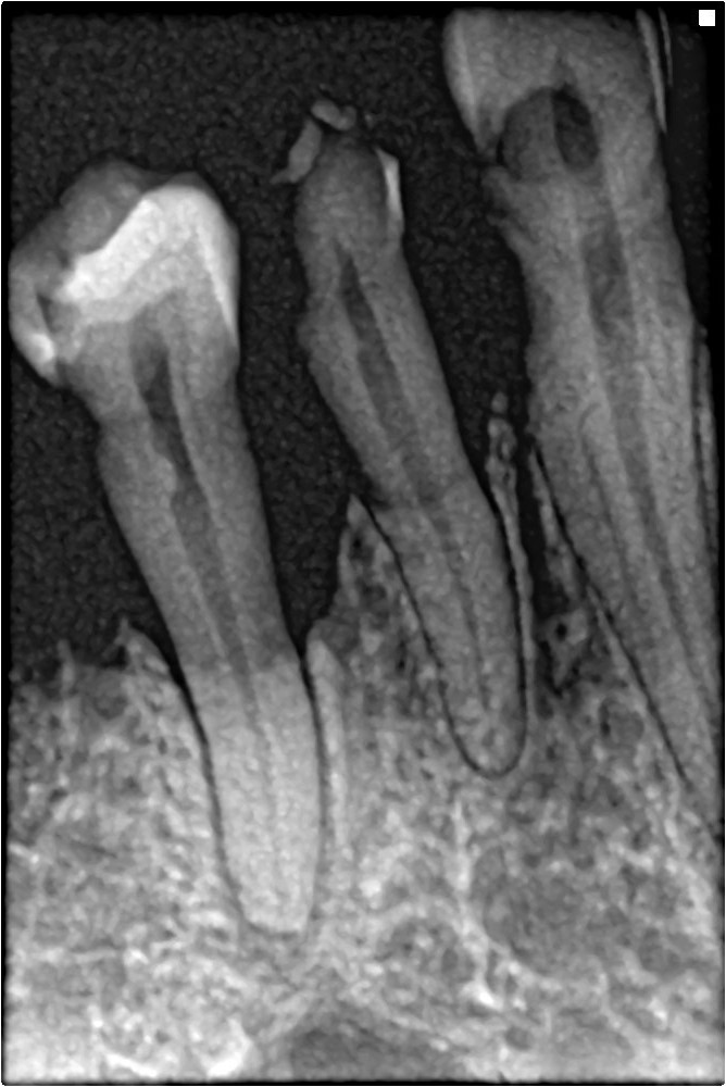 Bone_loss_in_periapical_xray.jpg