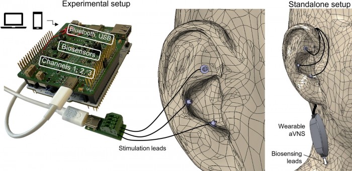 Auricular-Vagus-Nerve-Stimulation.jpg