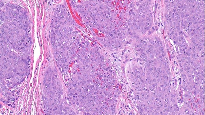 carcinoma_of_salivary_gland_945x532.jpg